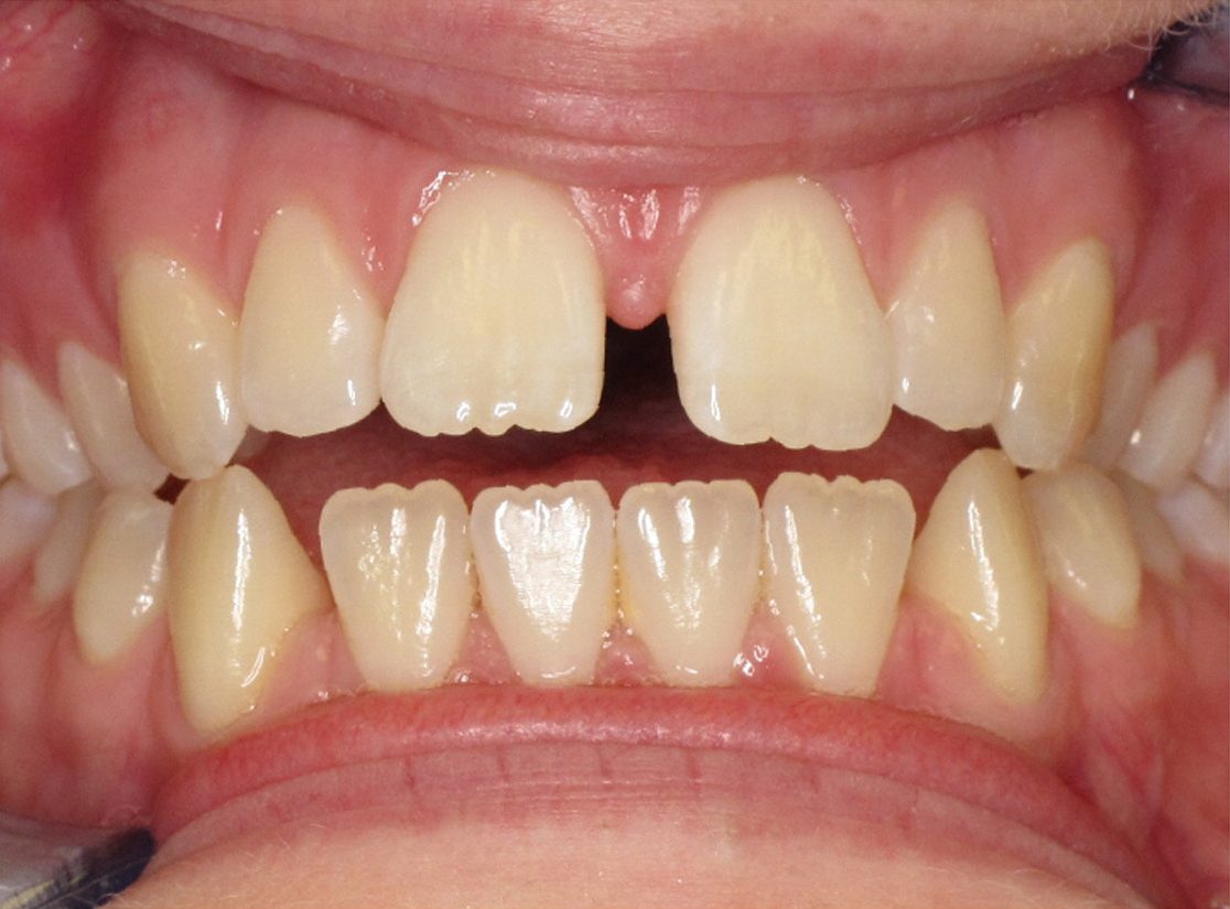 Close up of gap teeth